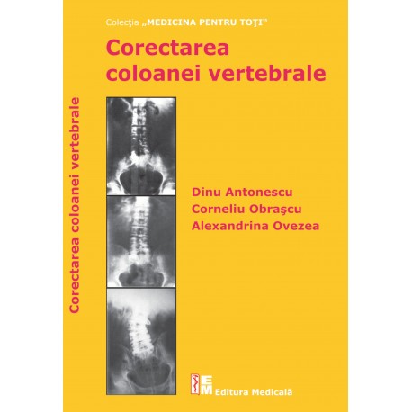Corectarea coloanei vertebrale - Dinu Antonescu, Corneliu Obraşcu, Alexandrina Ovezea